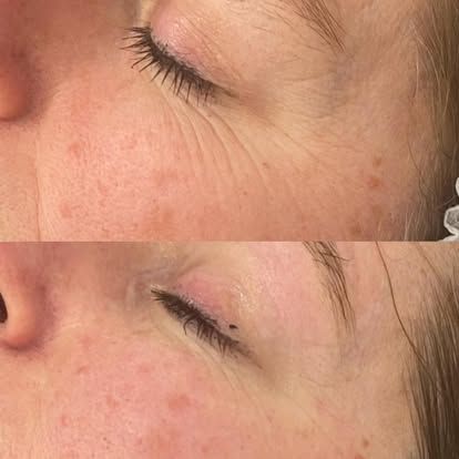 Top: Wrinkles around a closed eye. Bottom: Smoother skin around the same eye after a treatment.