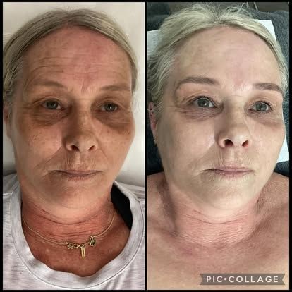 Before-and-after of a woman's face. Skin appears brighter, smoother in the 