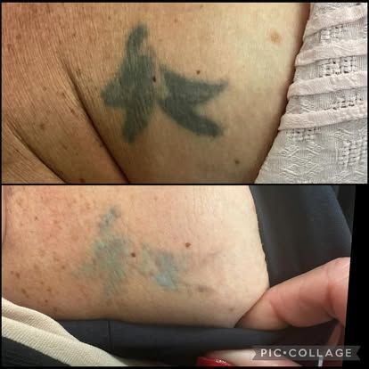 Comparison of a tattoo on an arm before and after laser removal treatment; faded teal hue.