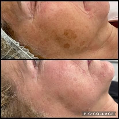 Comparison of skin before and after a treatment, showing reduced sun spots and improved skin tone.