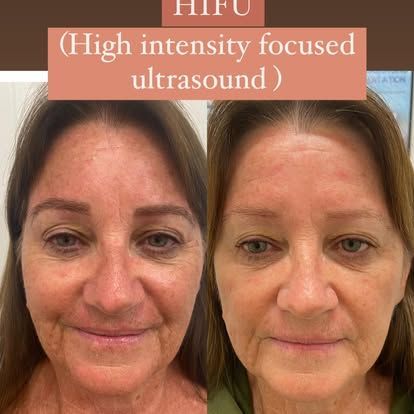 Side-by-side comparison of woman's face, before and after HIFU treatment; showing reduced wrinkles.