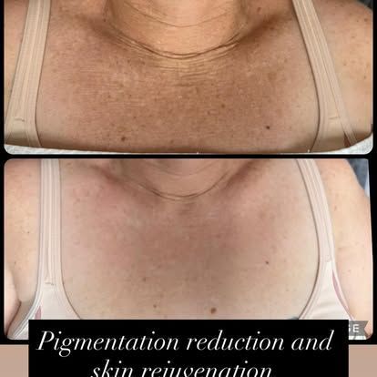 Before and after photos showing pigmentation reduction and skin rejuvenation on a person's chest.