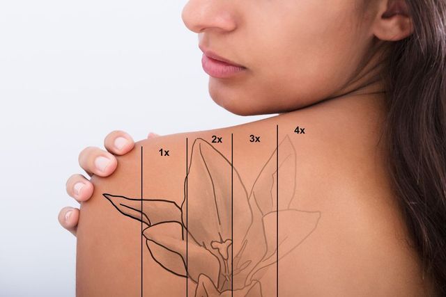 Woman's shoulder with a flower tattoo design, marked with lines showing stages for removal.