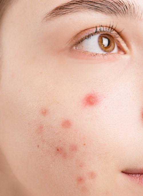 A close up of a woman 's face with acne and a brown eye.