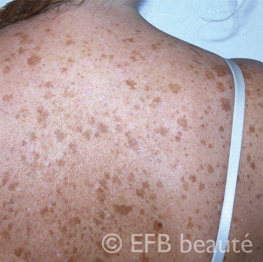 A woman 's back with freckles