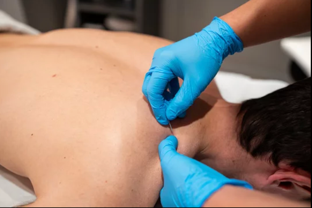 dry needling into a mans trap