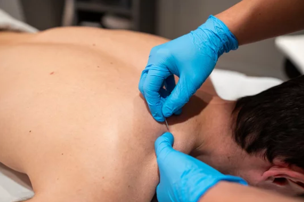 dry needling