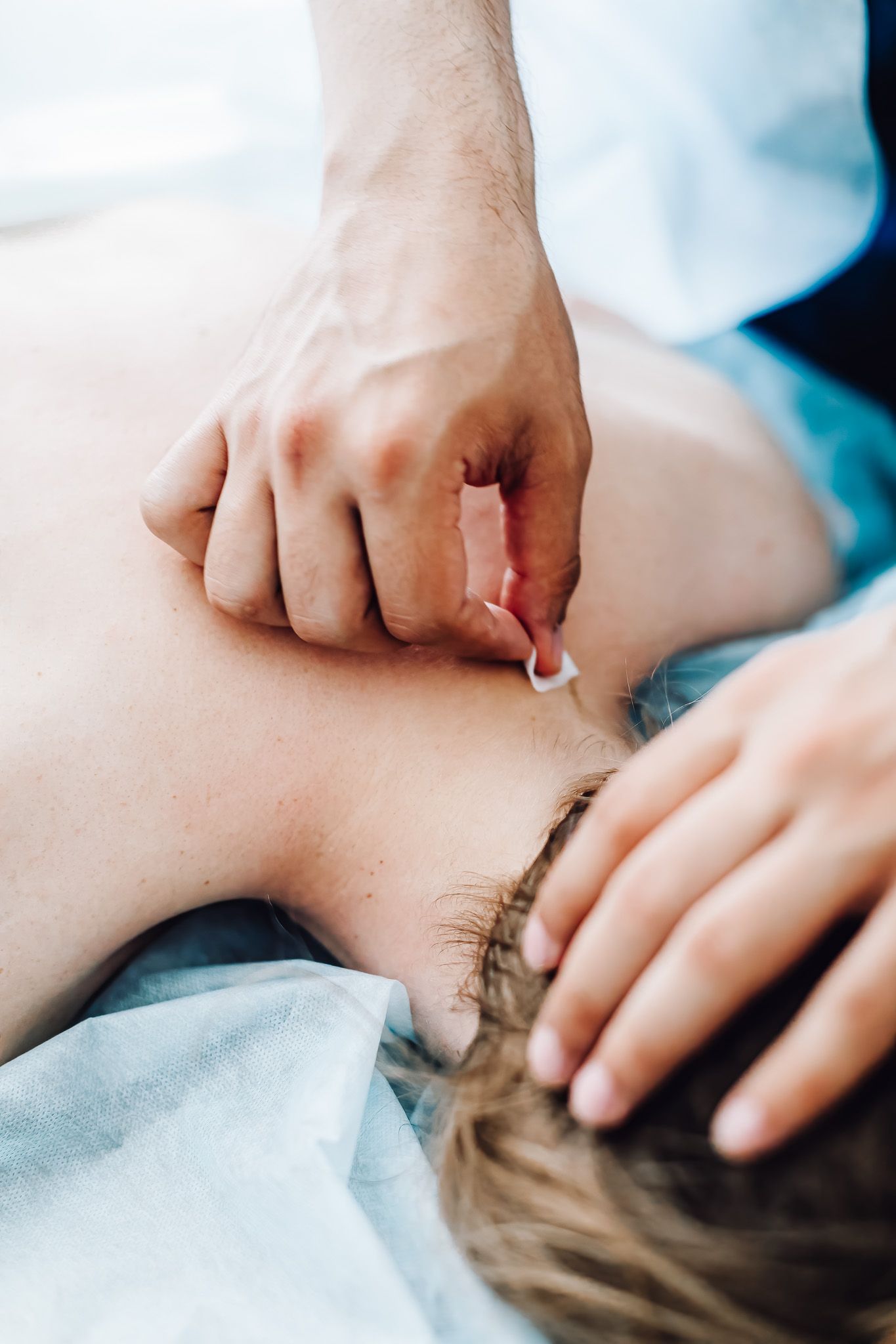 A person is getting an acupuncture treatment on their back.