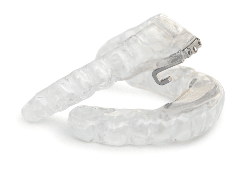 Clear oral appliance with metal under the front teeth used for sleep apnea therapy.