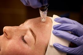 nala-med-spa-microneedling-and-collagen-induction-image
