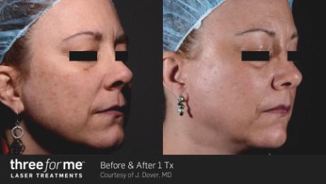 Before and After 3 For Me Treatment — Brighton, MI — Dermatology Specialists of Brighton
