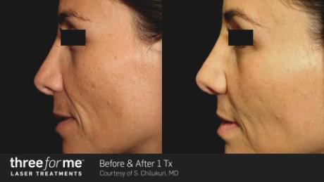 Before and After Treatment Result — Brighton, MI — Dermatology Specialists of Brighton