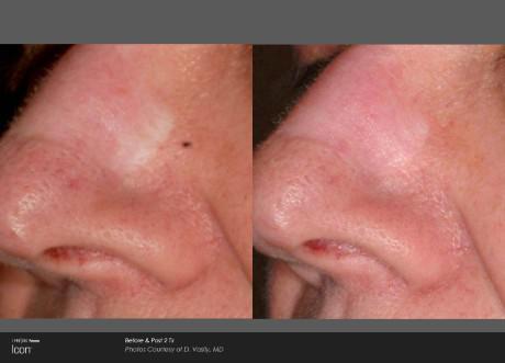 Nose Scar Removal — Brighton, MI — Dermatology Specialists of Brighton