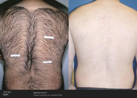 Back Hair Removal — Brighton, MI — Dermatology Specialists of Brighton