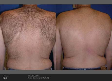 Before and After Hair Removal — Brighton, MI — Dermatology Specialists of Brighton