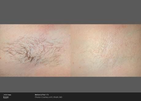 Armpit Hair Removal — Brighton, MI — Dermatology Specialists of Brighton