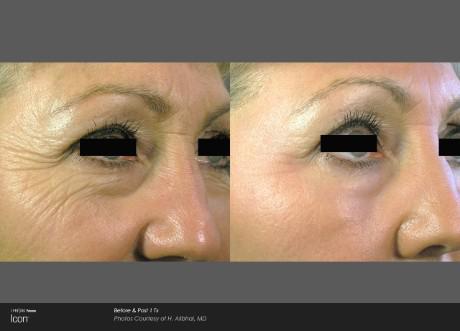 Before and After Wrinkle Reduction — Brighton, MI — Dermatology Specialists of Brighton