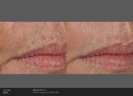 Lip Wrinkles — Brighton, MI — Dermatology Specialists of Brighton