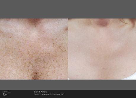 Chest Freckles — Brighton, MI — Dermatology Specialists of Brighton