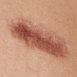 Scars — Brighton, MI — Dermatology Specialists of Brighton
