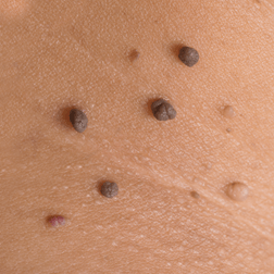 Moles — Brighton, MI — Dermatology Specialists of Brighton