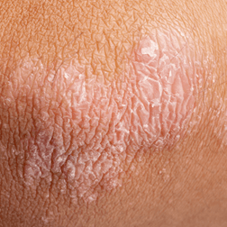 Psoriasis — Brighton, MI — Dermatology Specialists of Brighton