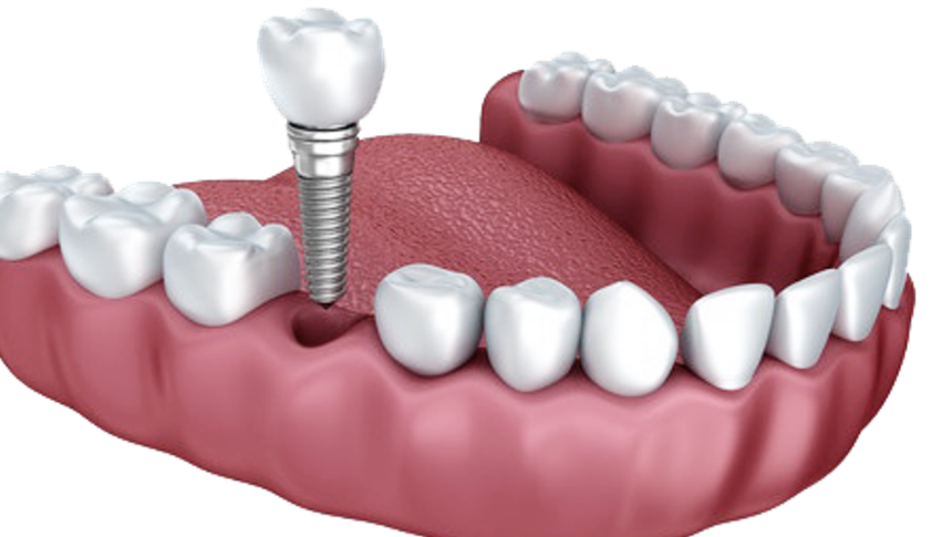 A close up of a tooth with a screw in it.