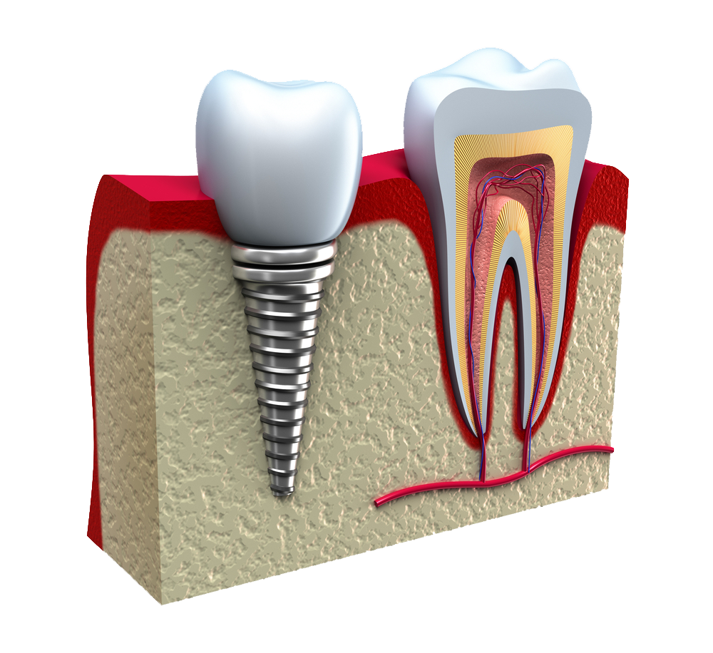 A model of a tooth with a dental implant in it.