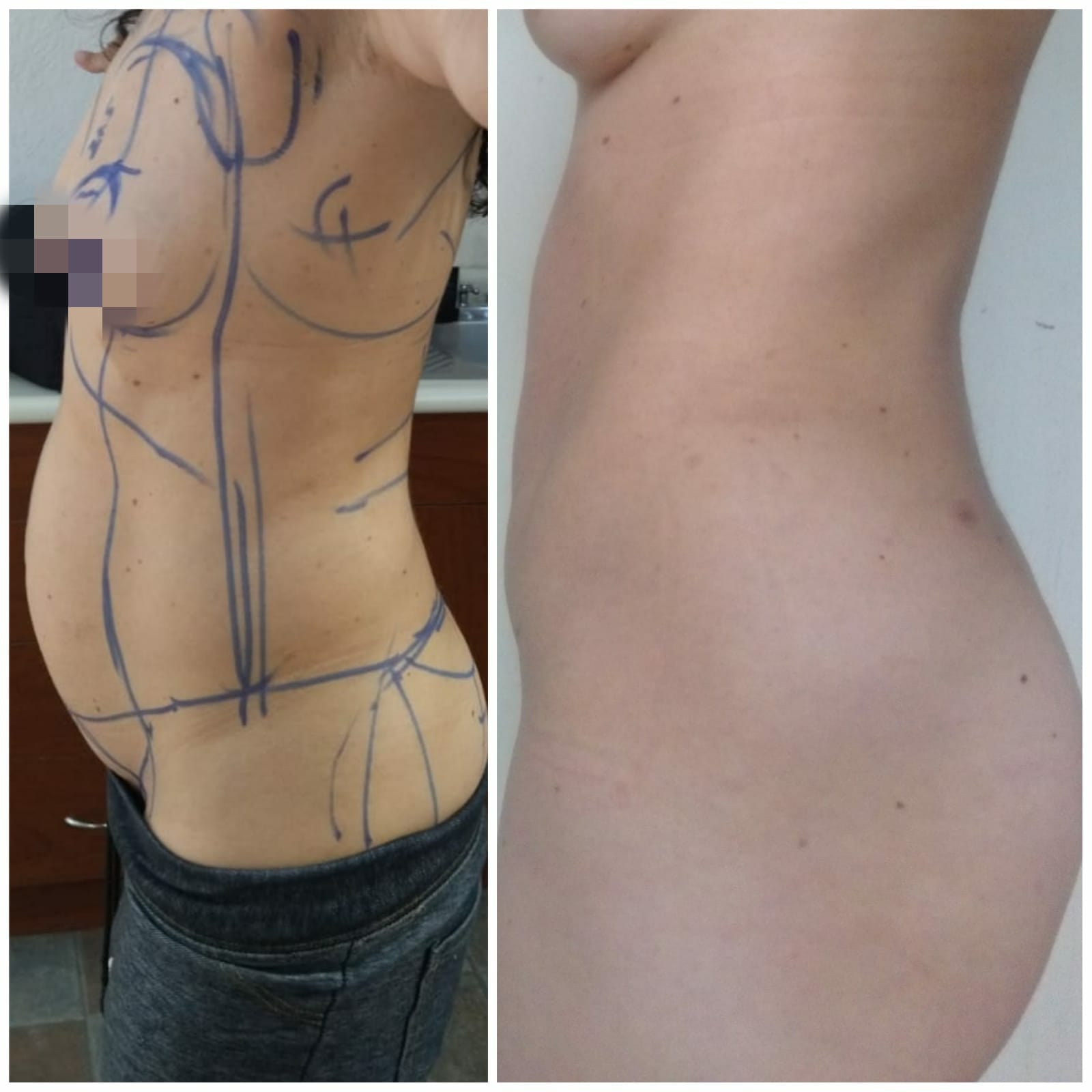 Abdominoplastia con liposucción Abdominoplastia con liposucción
