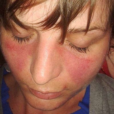 a close up of a woman 's face with red spots on it .