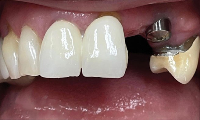 A close up of a person 's teeth with a missing tooth.