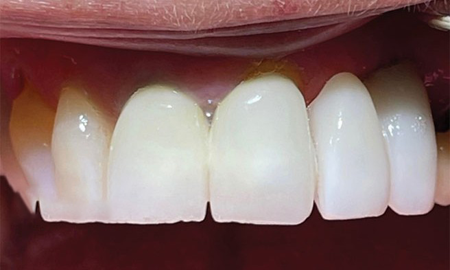 A close up of a person 's teeth with the words `` after '' written on the bottom.