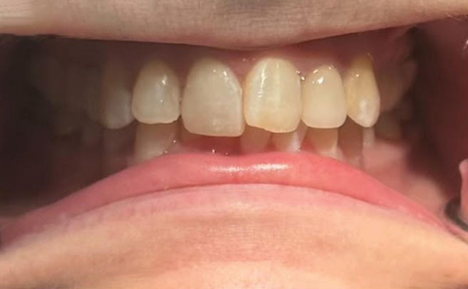 A close up of a person 's teeth and mouth.