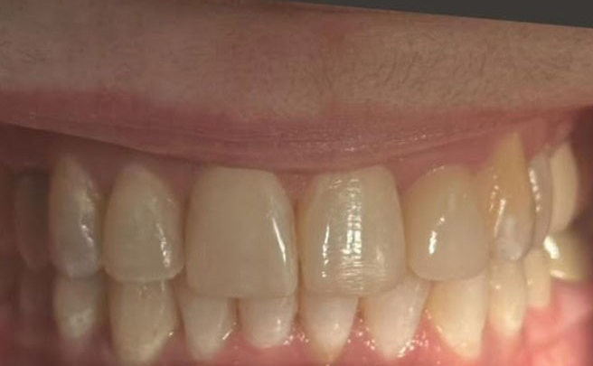 A close up of a person 's teeth with the words after on the bottom