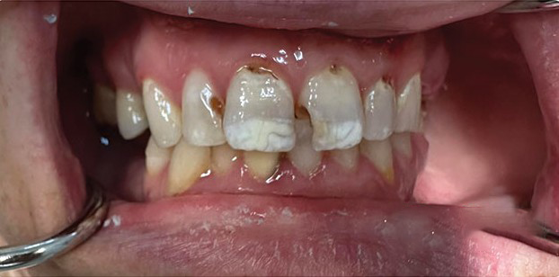 A close up of a person 's teeth with a ring in their mouth.
