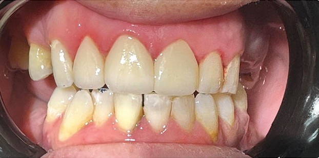 A close up of a person 's teeth in a mouth guard.
