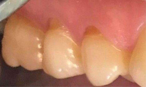 A close up of a person 's teeth with pink gums.