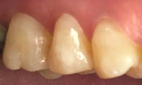 A close up of a person 's teeth and gums.