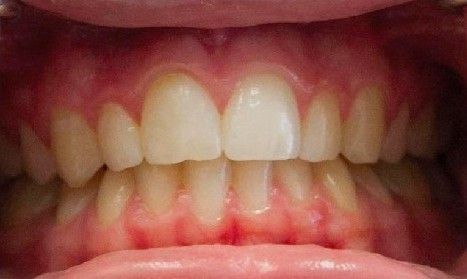 A close up of a person 's teeth and mouth.