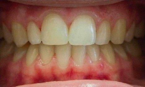 A close up of a person 's teeth with white teeth and red gums.