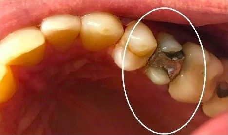 A close up of a person 's teeth with a white circle around it.