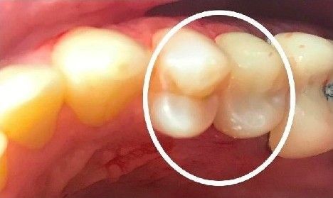 A close up of a person 's teeth with a white circle around them.