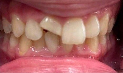 A close up of a person 's teeth with a broken tooth.