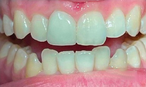 A close up of a person 's teeth with white teeth.