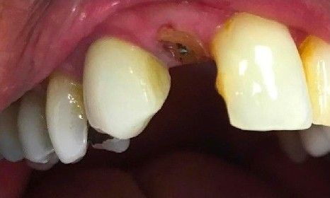 A close up of a person 's teeth with a missing tooth.