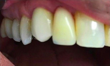 A close up of a person 's teeth in their mouth.