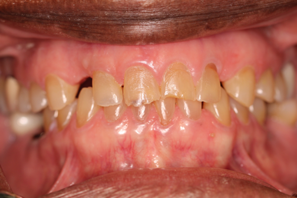 A close up of a person 's teeth with a missing tooth.