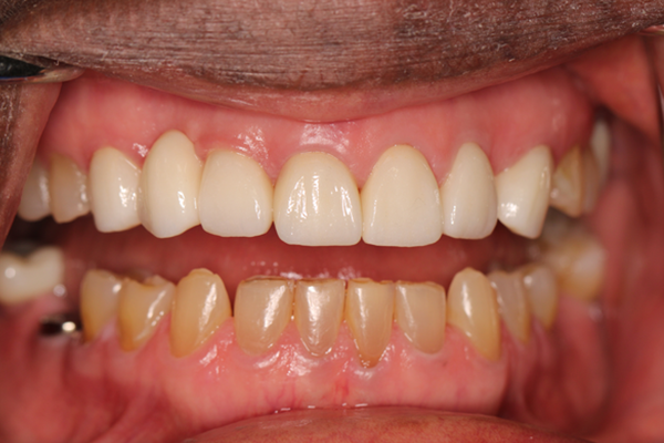 A close up of a person 's teeth with the words `` after '' written on the bottom.