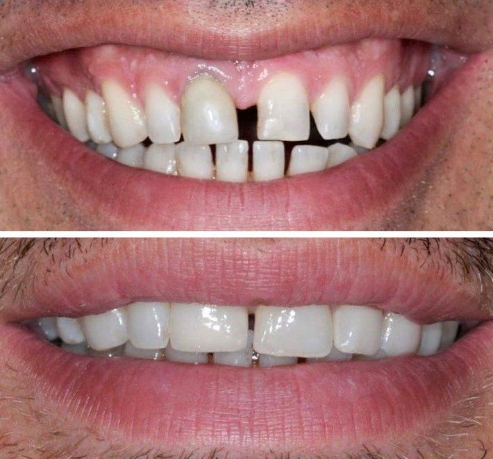 Ricostruzione del sorriso