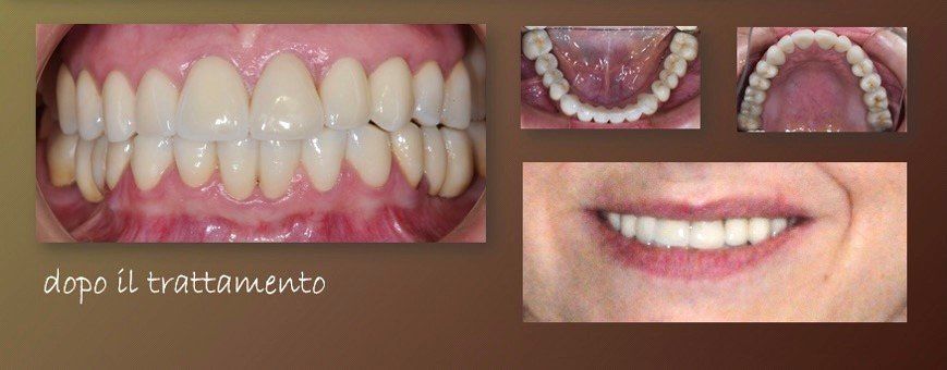 odontoiatria estetica dopo